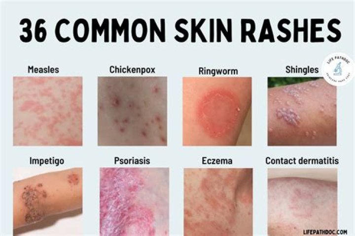 Does skin to skin reduce SIDS?