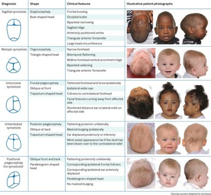 Does smoking cause craniosynostosis?