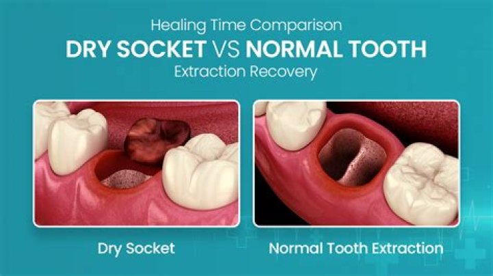 Does Tylenol help dry socket?