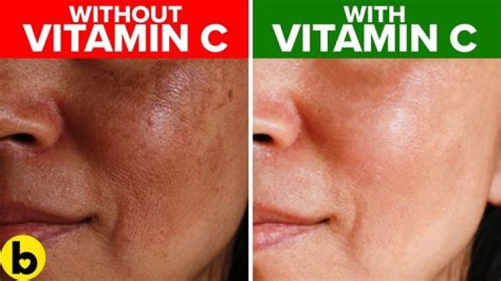 Does vitamin C make eczema worse?
