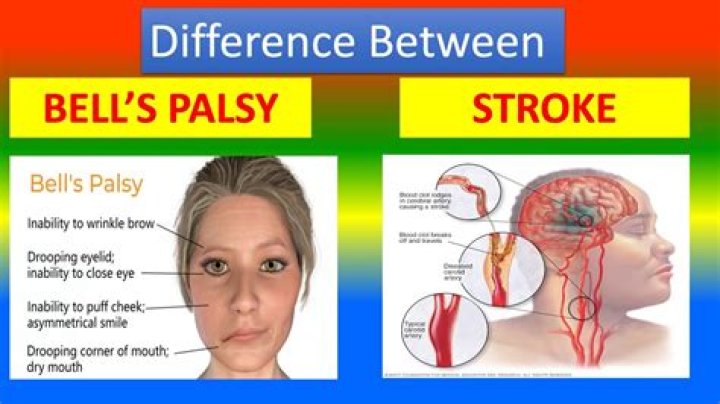 How can you tell the difference between a stroke and Bell's palsy?