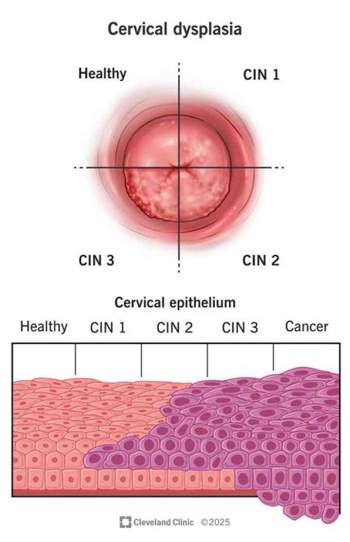 How common is high-grade cervical dysplasia?