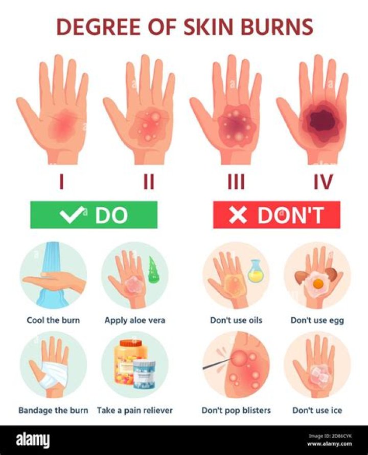 How do burn victims feel?