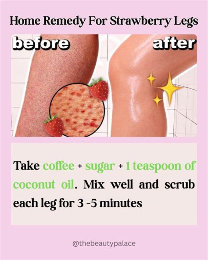 How do dermatologists get rid of Strawberry legs?