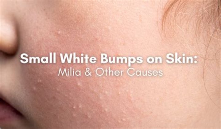How do I get rid of little bumps on my face?
