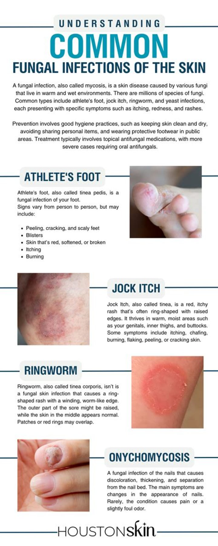 How do I know if I have a fungal infection on my feet?