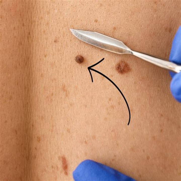 How do I know if its a mole or skin tag?