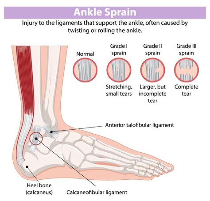 How do I know if my ankle sprain is grade 1 or 2?