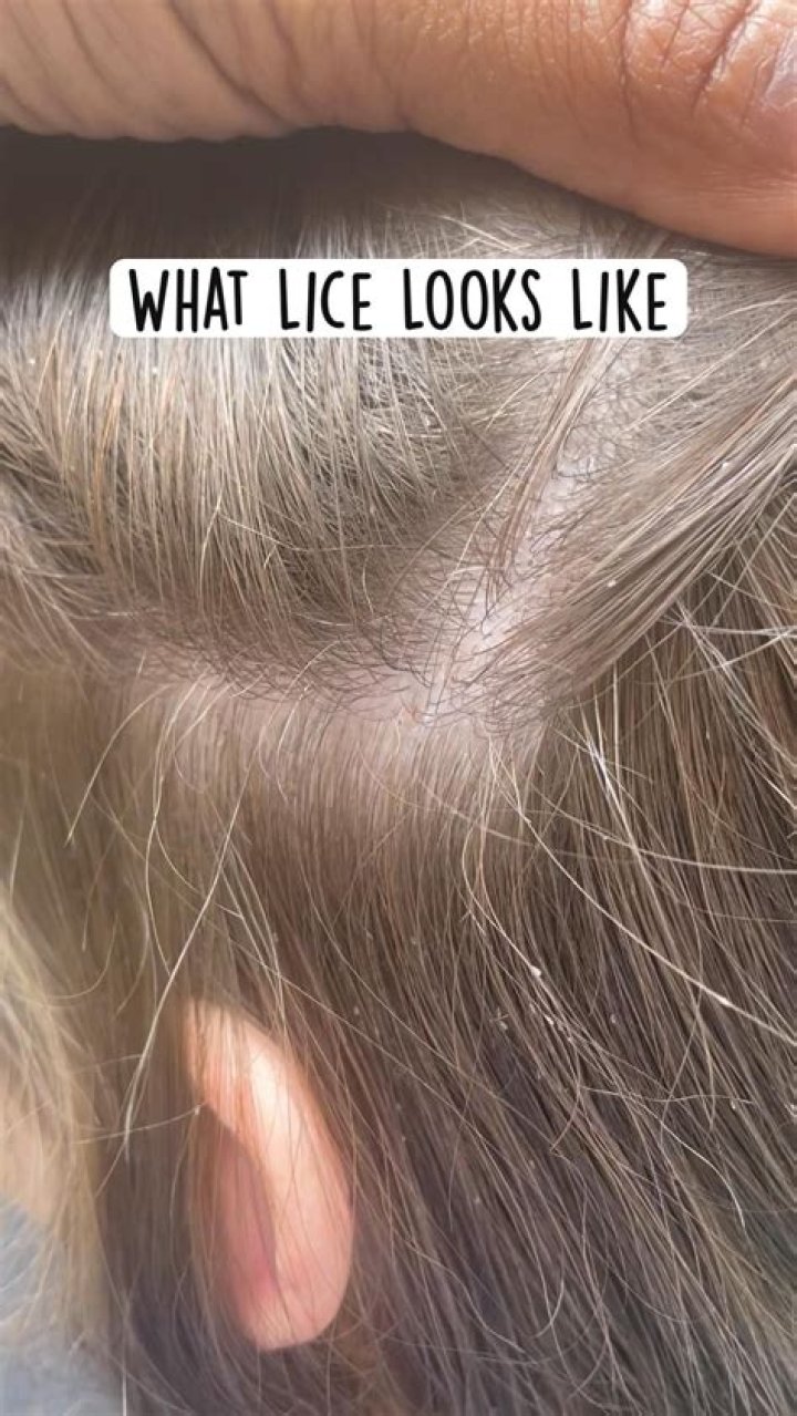 How do lice start?