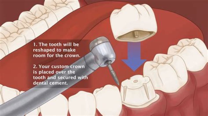 How do you avoid crowns?