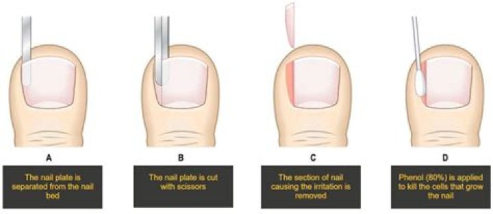How do you cut an ingrown toenail painlessly?