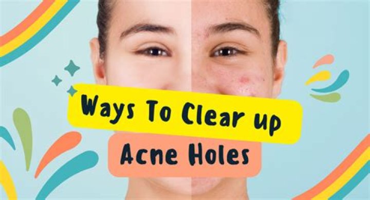 How do you fill acne pits?