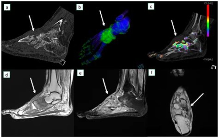 How do you fix osteonecrosis?