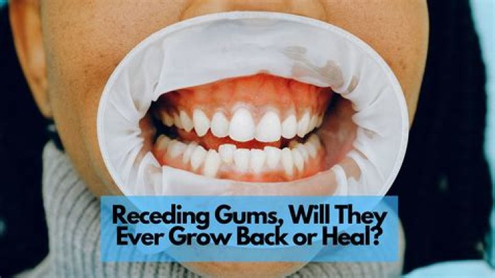 How do you fix severely receding gums?