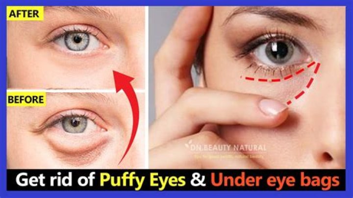 How do you get rid of baggy eyelids?