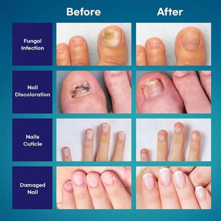How do you get rid of thick toenail fungus?