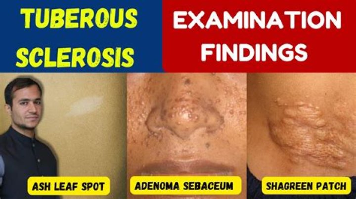 How do you get tuberous sclerosis?