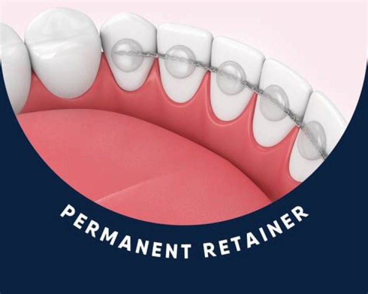 How do you get white plaque off retainers?