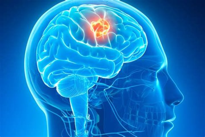 How do you know if a headache is a brain tumor?