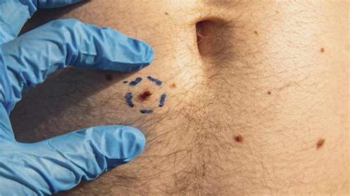 How do you know if a spot is cancerous?