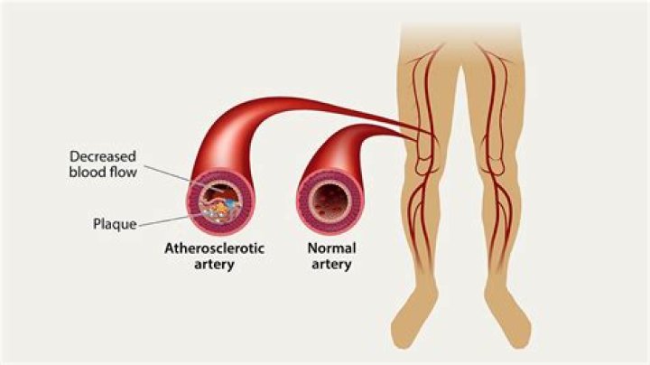 How do you know if you have blocked arteries in your legs?