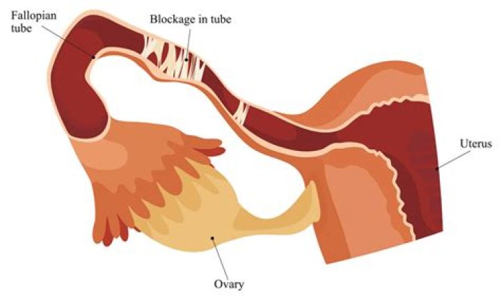How do you know if you have blocked fallopian tubes?