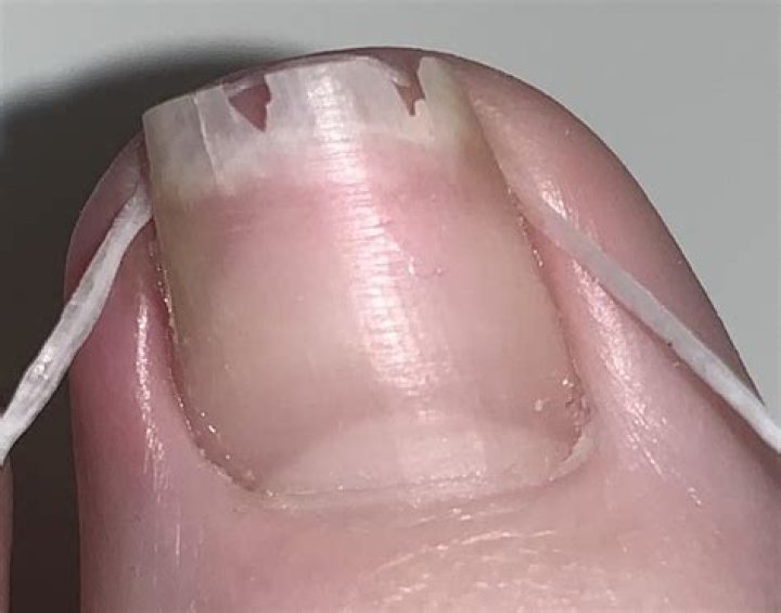 How do you put dental floss under an ingrown toenail?