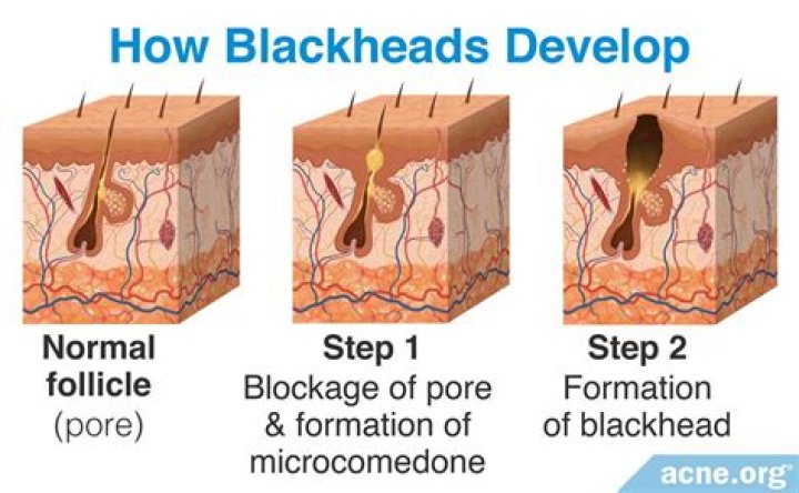 How do you remove a deep blackhead?
