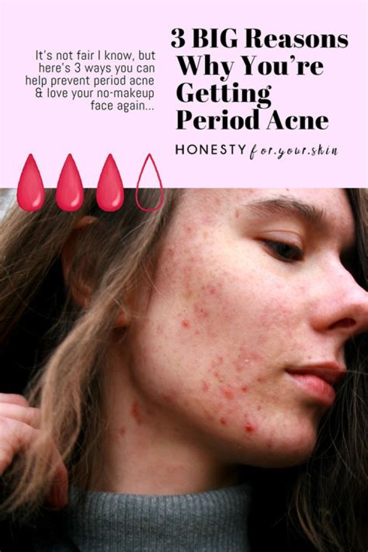 How do you treat period acne?