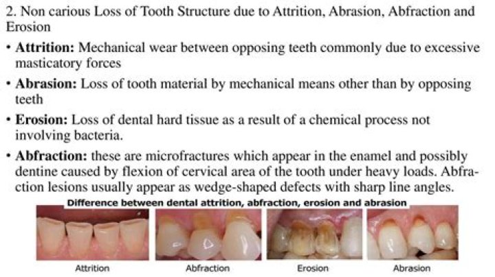 How is attrition diagnosed?