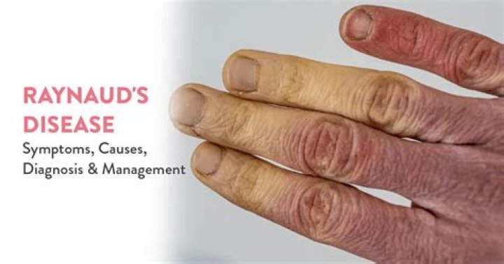 How is Raynaud's diagnosed?
