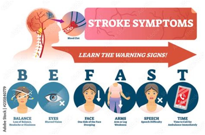 How long after a stroke can you get dementia?