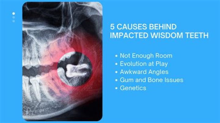 How long are you asleep for wisdom teeth?
