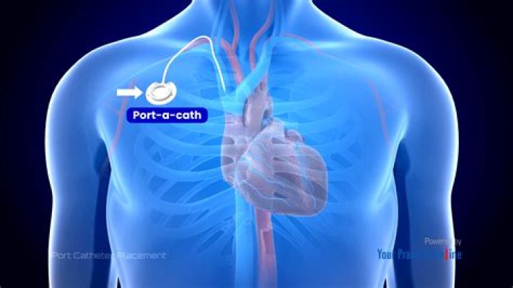 How long are you sore after a port placement?