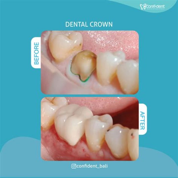 How long can a tooth go without a crown?