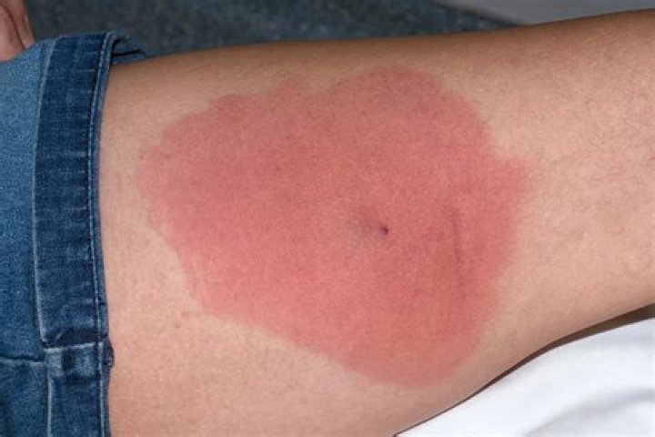How long can MRSA go untreated?