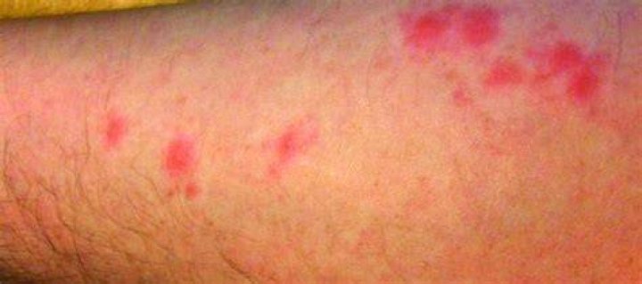 How long do bed bug bites last on your skin?