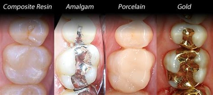 How long do tooth fillings last?