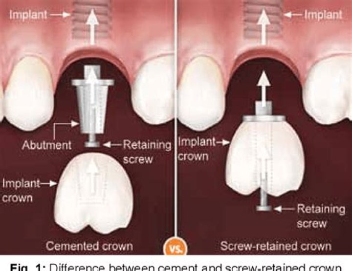 How long does a cemented crown last?