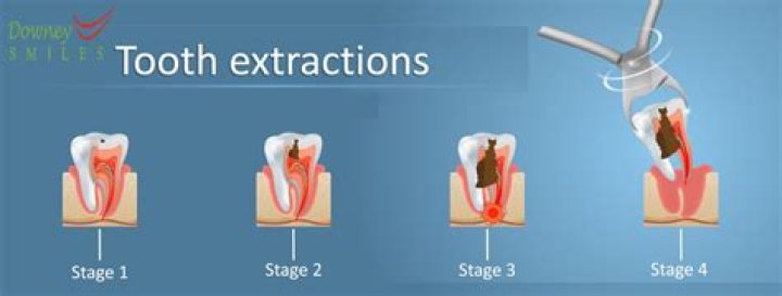 How long does a single tooth extraction take?