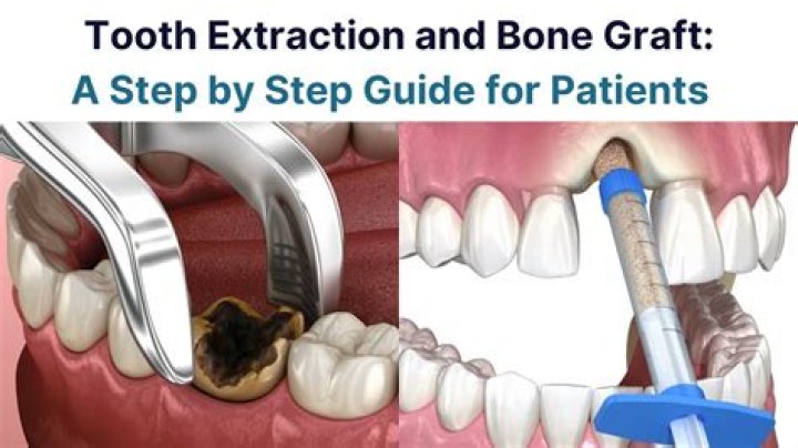 How long does a tooth extraction and bone graft procedure take?