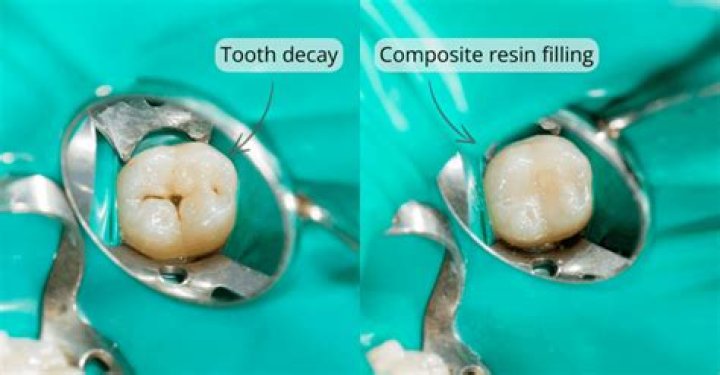 How long does glass ionomer last?