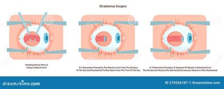 How long does it take for the eye to heal after strabismus surgery?