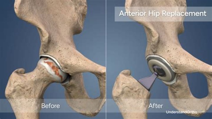 How long does it take to completely heal from hip replacement?