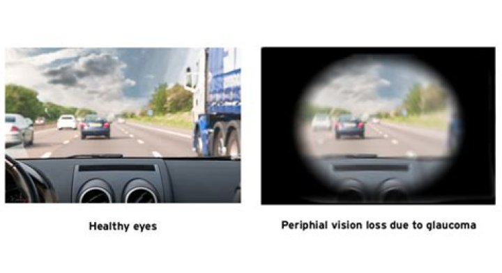How long does it take to lose vision with glaucoma?