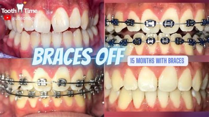 How long does it take to notice changes with braces?
