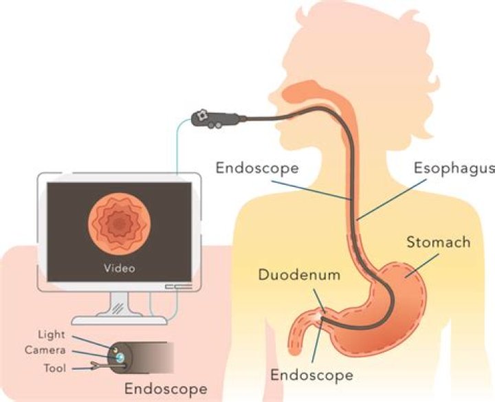 How long is sleep for endoscopy?