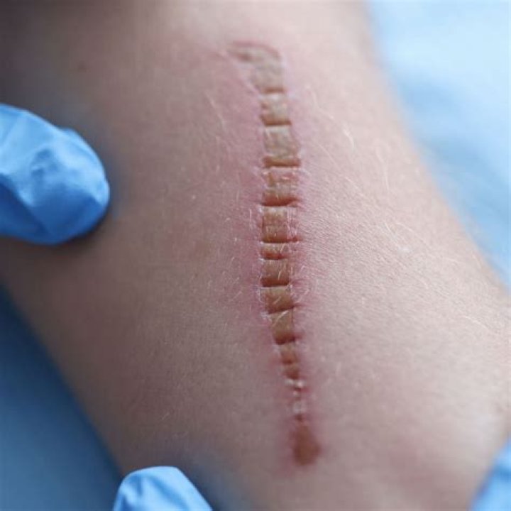 How long will my incision hurt?