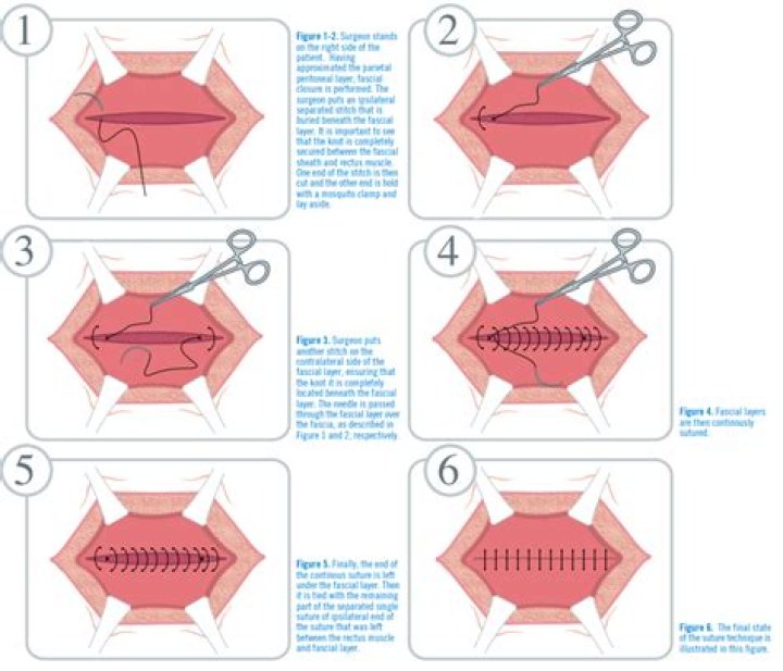 How many layers are stitched during C-section?