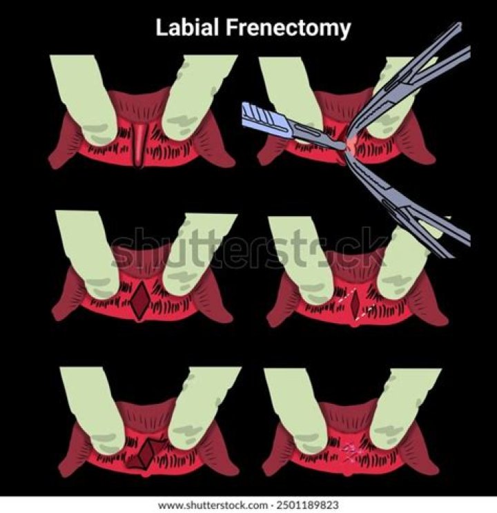 How much does a labial Frenectomy cost?